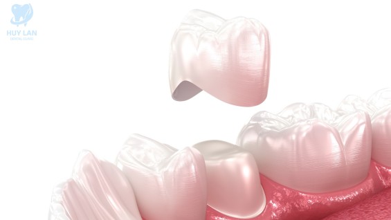 Bọc răng sứ