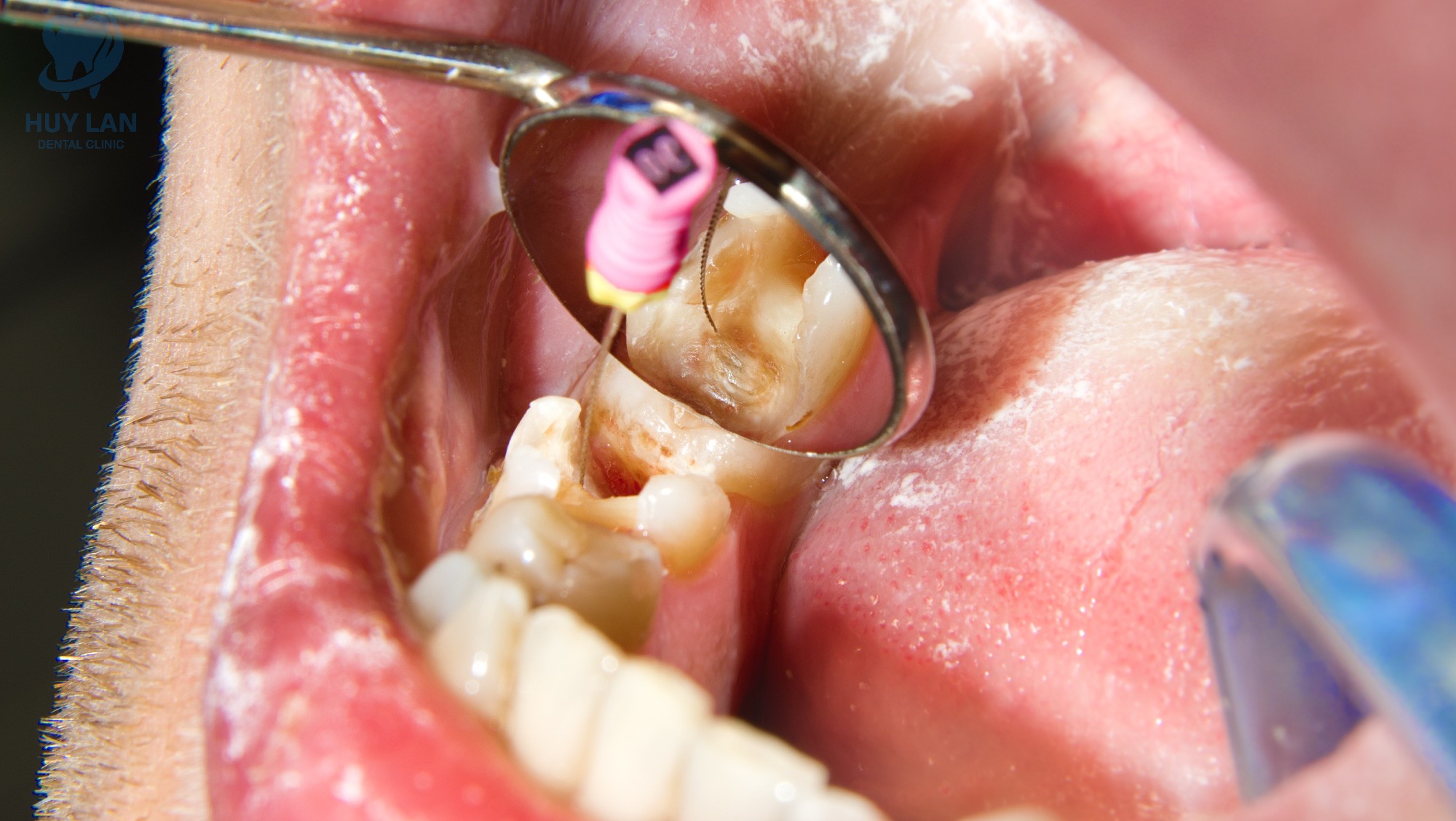 CÁC BỆNH LÝ RĂNG MIỆNG THƯỜNG GẶP 