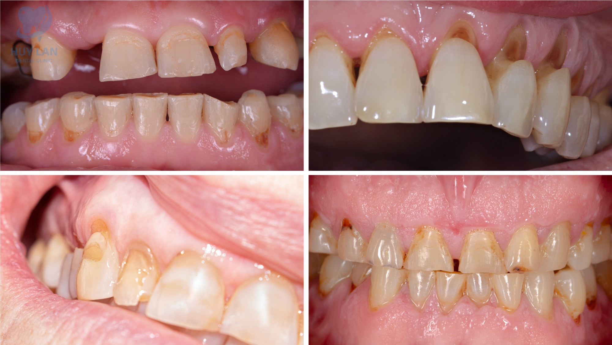 CÁC TRƯỜNG HỢP NÊN CHỮA CƯỜI HỞ LỢI CÁC TRƯỜNG HỢP NÊN CHỮA CƯỜI HỞ LỢI