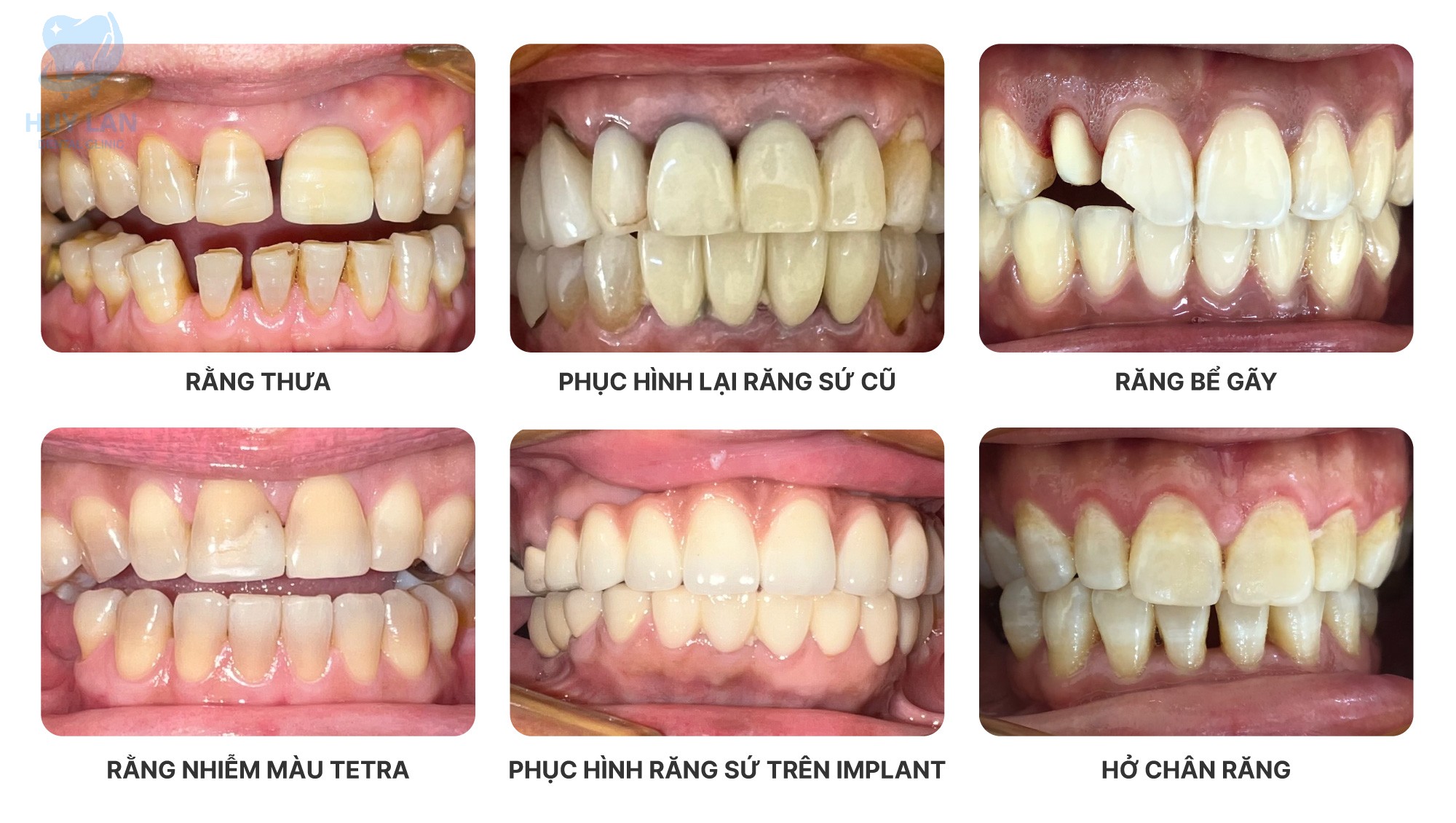 CÁC TRƯỜNG HỢP <br>NÊN  SỬ DỤNG <br>NHA KHOA THẨM MỸ CÁC TRƯỜNG HỢP <br>NÊN  SỬ DỤNG <br>NHA KHOA THẨM MỸ