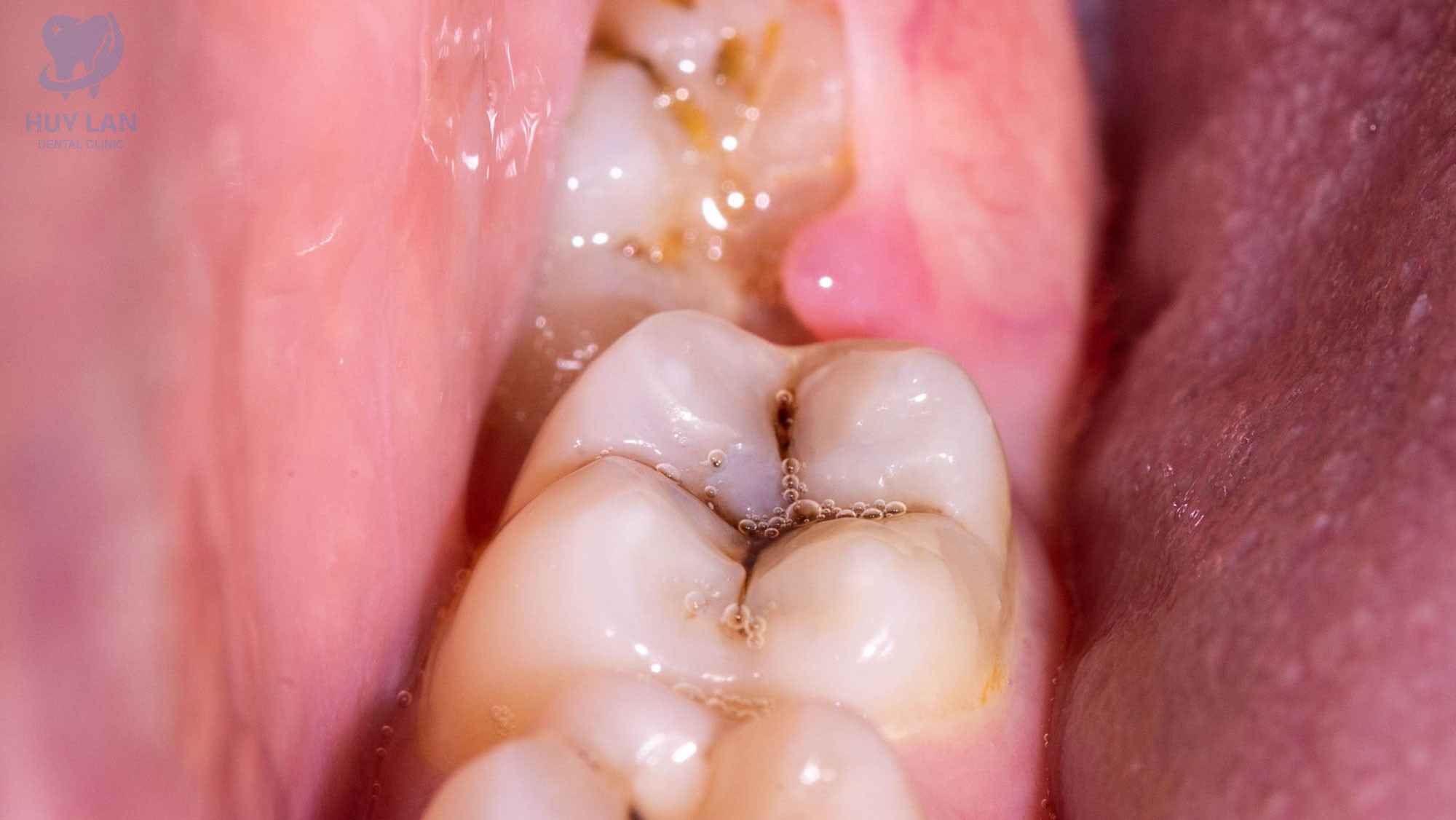 CÁC VẤN ĐỀ THƯỜNG GẶP LIÊN QUAN ĐẾN RĂNG KHÔN: