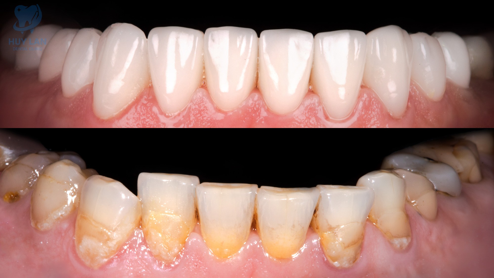 CẠO VÔI, ĐÁNH BÓNG RĂNG LÀ GÌ?