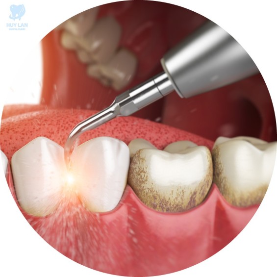 Cạo vôi và đánh bóng răng