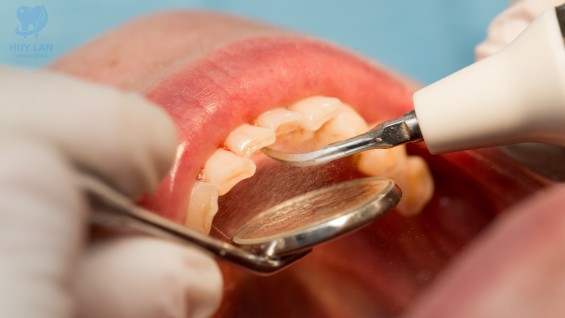 Cạo vôi, đánh bóng răng