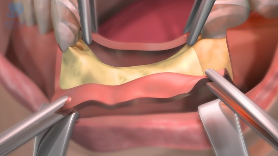 Chữa cười hở lợi bằng dao 