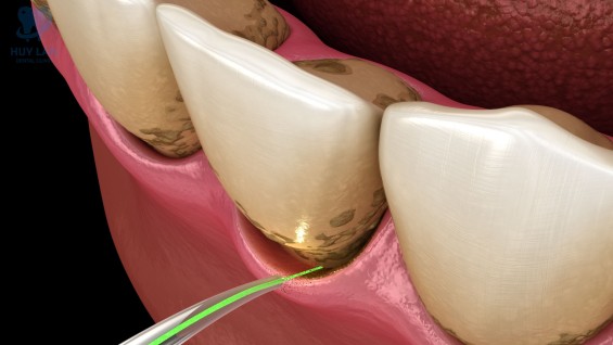 Chữa cười hở lợi <br>bằng điện