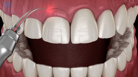 Chữa cười hở lợi <br>bằng laser