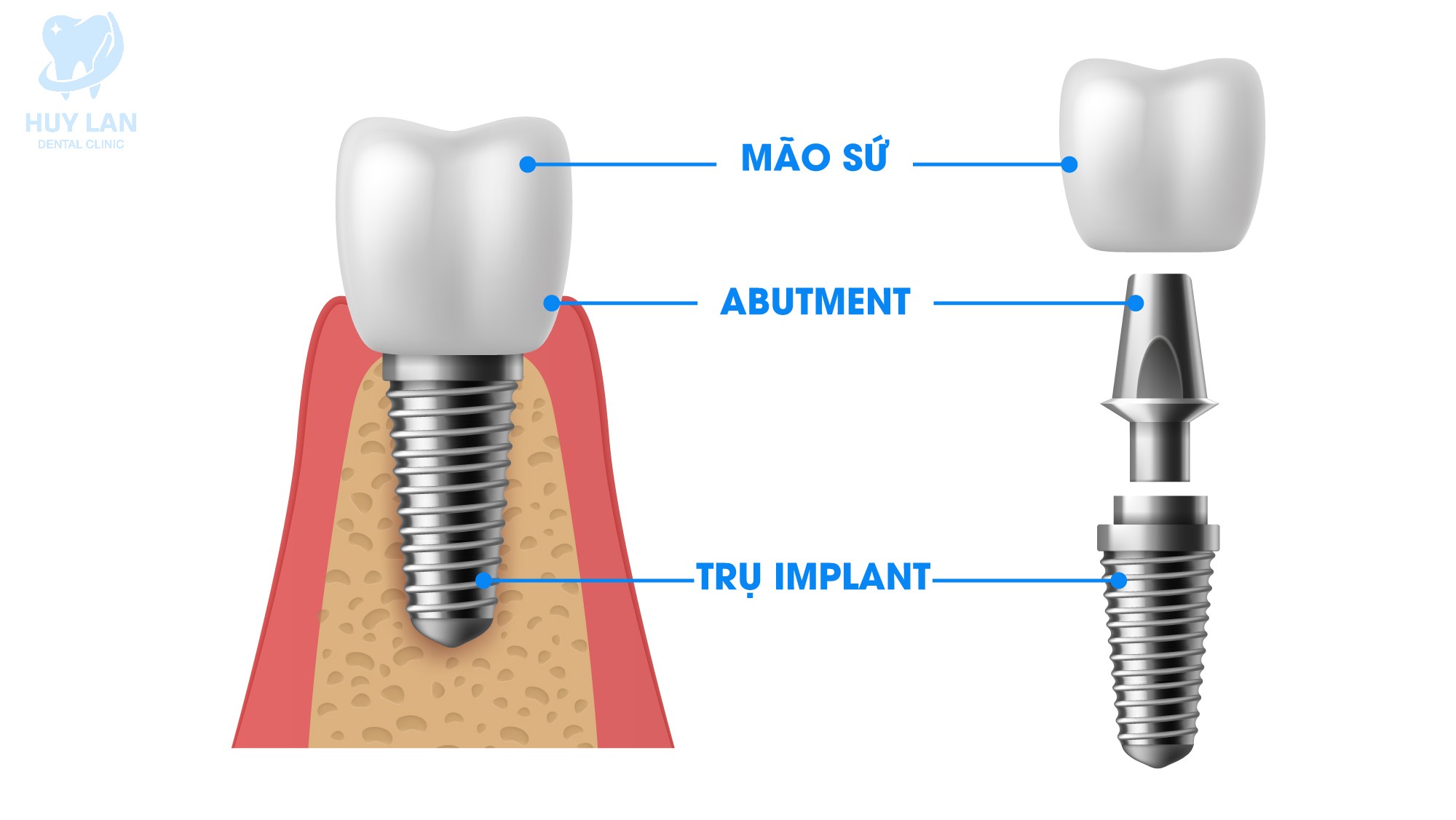 TRỒNG RĂNG IMPLANT <br>LÀ GÌ?