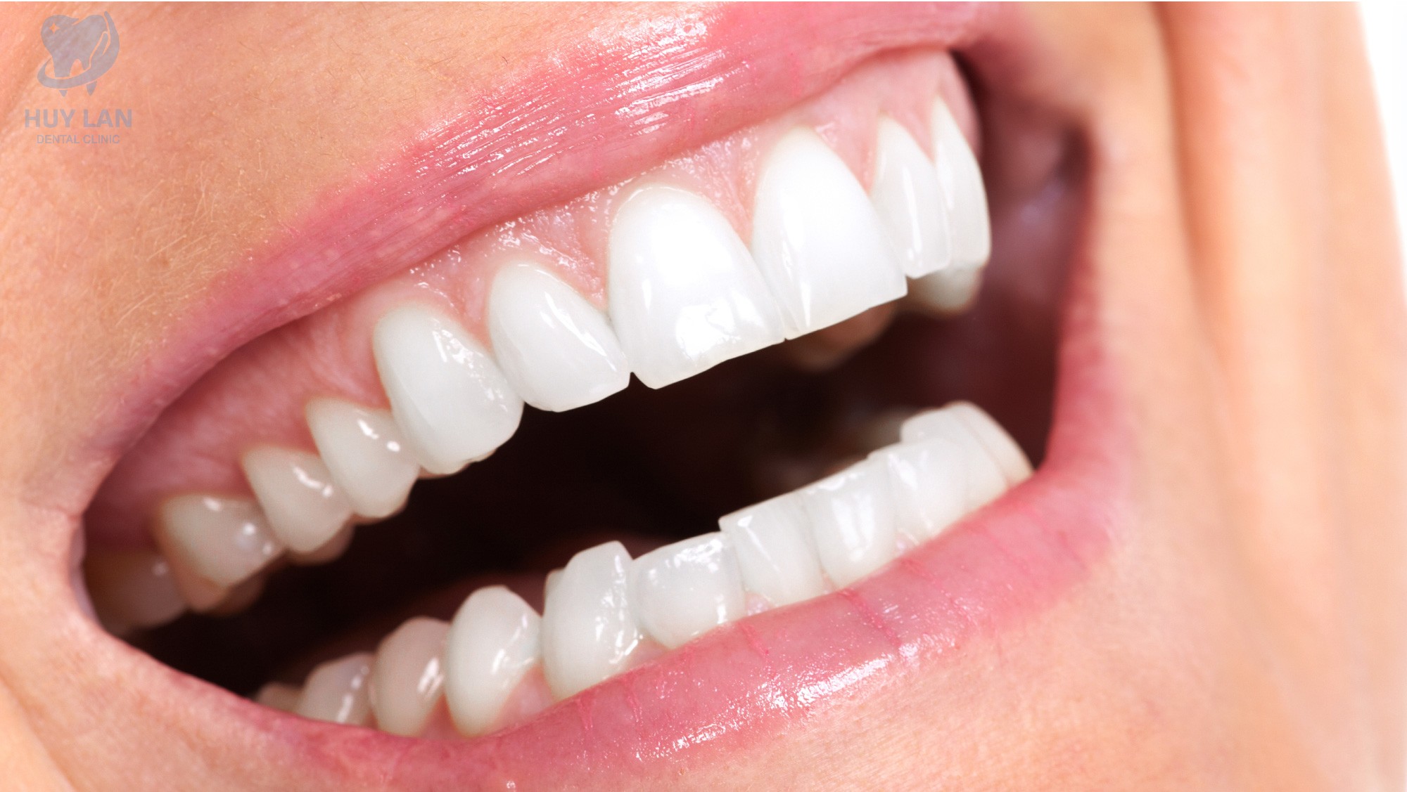 CÔNG DỤNG CỦA VIỆC CẠO VÔI, ĐÁNH BÓNG RĂNG ĐỊNH KỲ