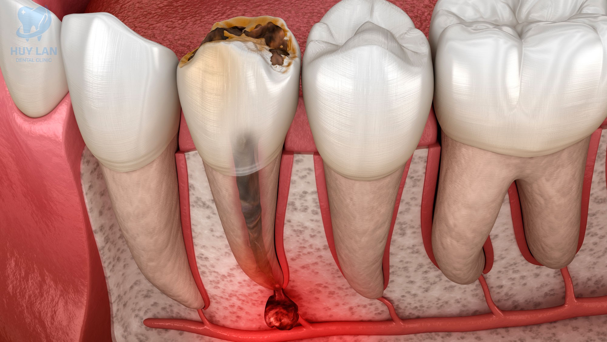 ĐIỀU TRỊ TỦY LÀ GÌ?