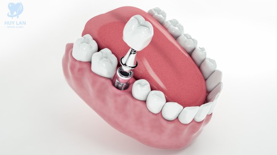 Trồng răng Implant đơn lẻ