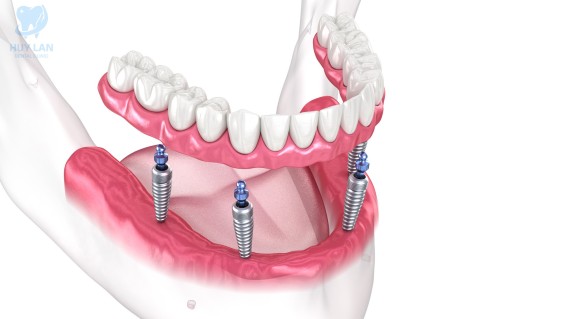 Trồng răng Implant toàn hàm