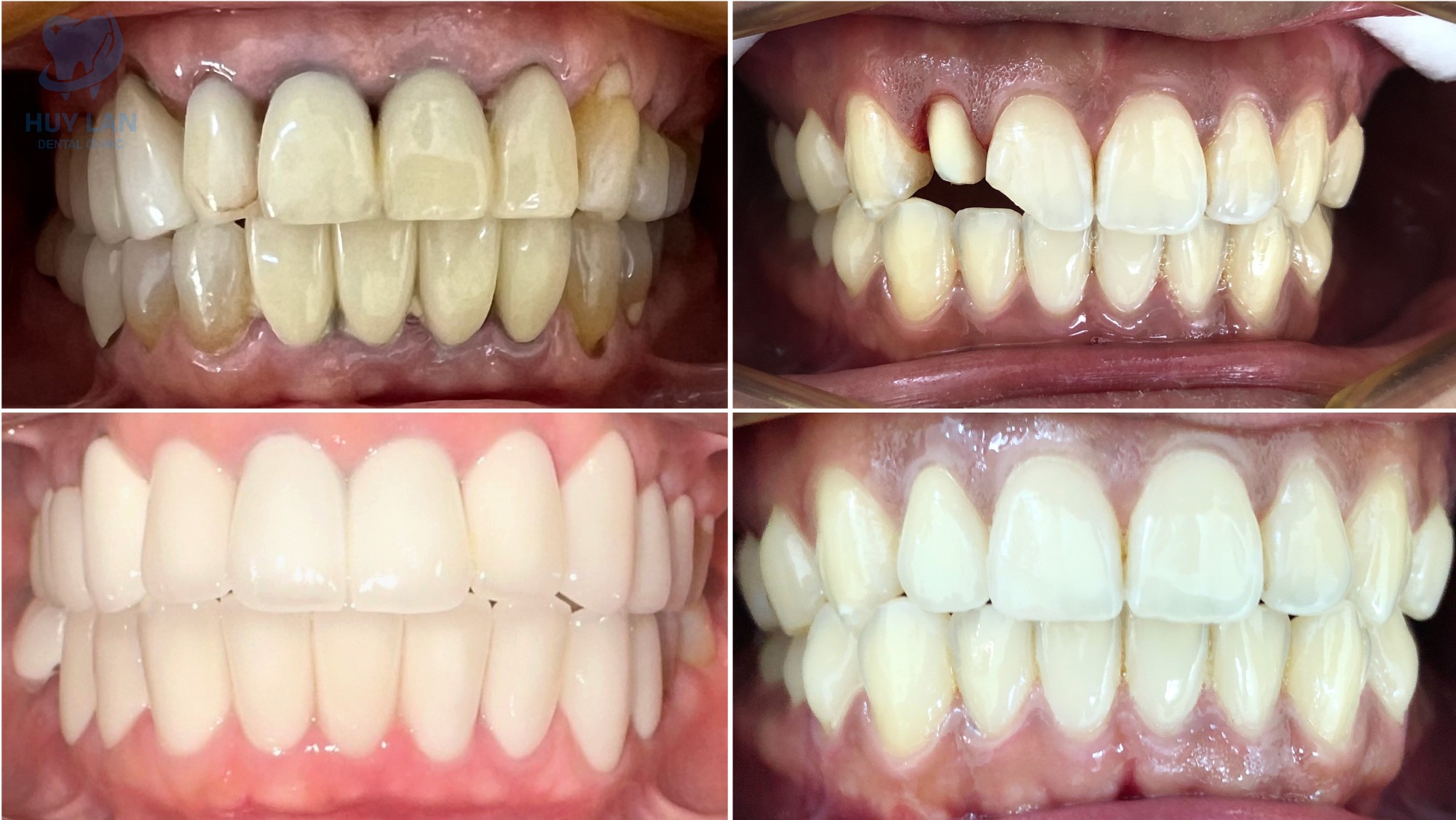 LỢI ÍCH BỌC RĂNG SỨ