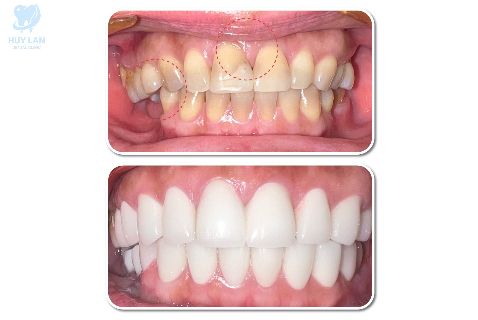 LỢI ÍCH KHI LÀM RĂNG THẨM MỸ LỢI ÍCH KHI LÀM RĂNG THẨM MỸ