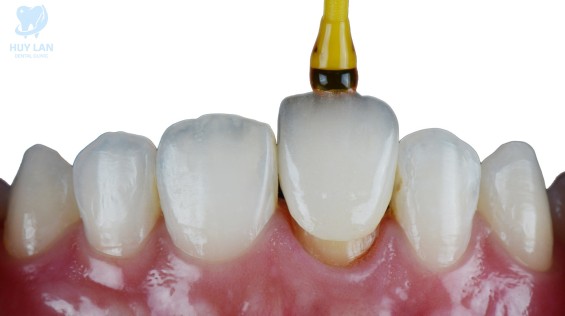 Mặt dán sứ Veneer