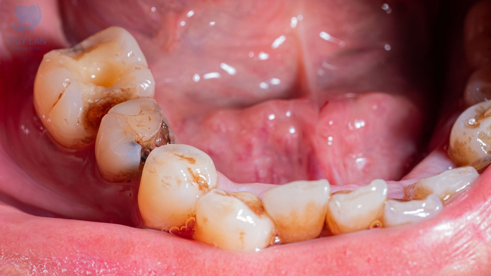 NHỮNG AI NÊN ĐIỀU TRỊ TỦY RĂNG 