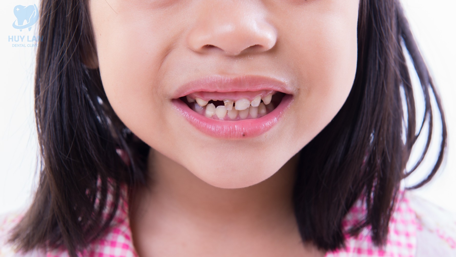 NHỮNG BỆNH LÝ RĂNG MIỆNG THƯỜNG GẶP Ở TRẺ NHỎ