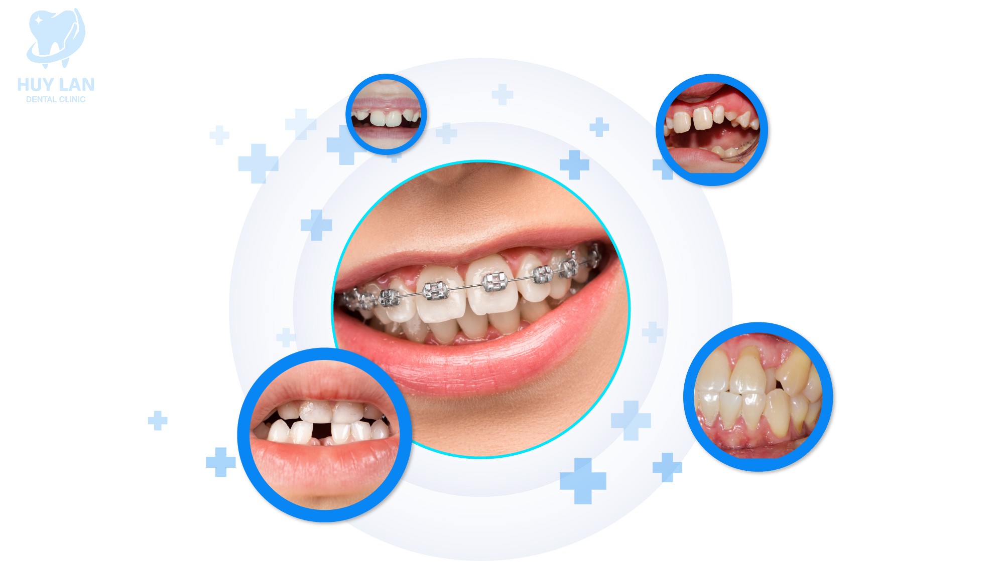 NHỮNG TRƯỜNG HỢP NÊN NIỀNG RĂNG MẮC CÀI 