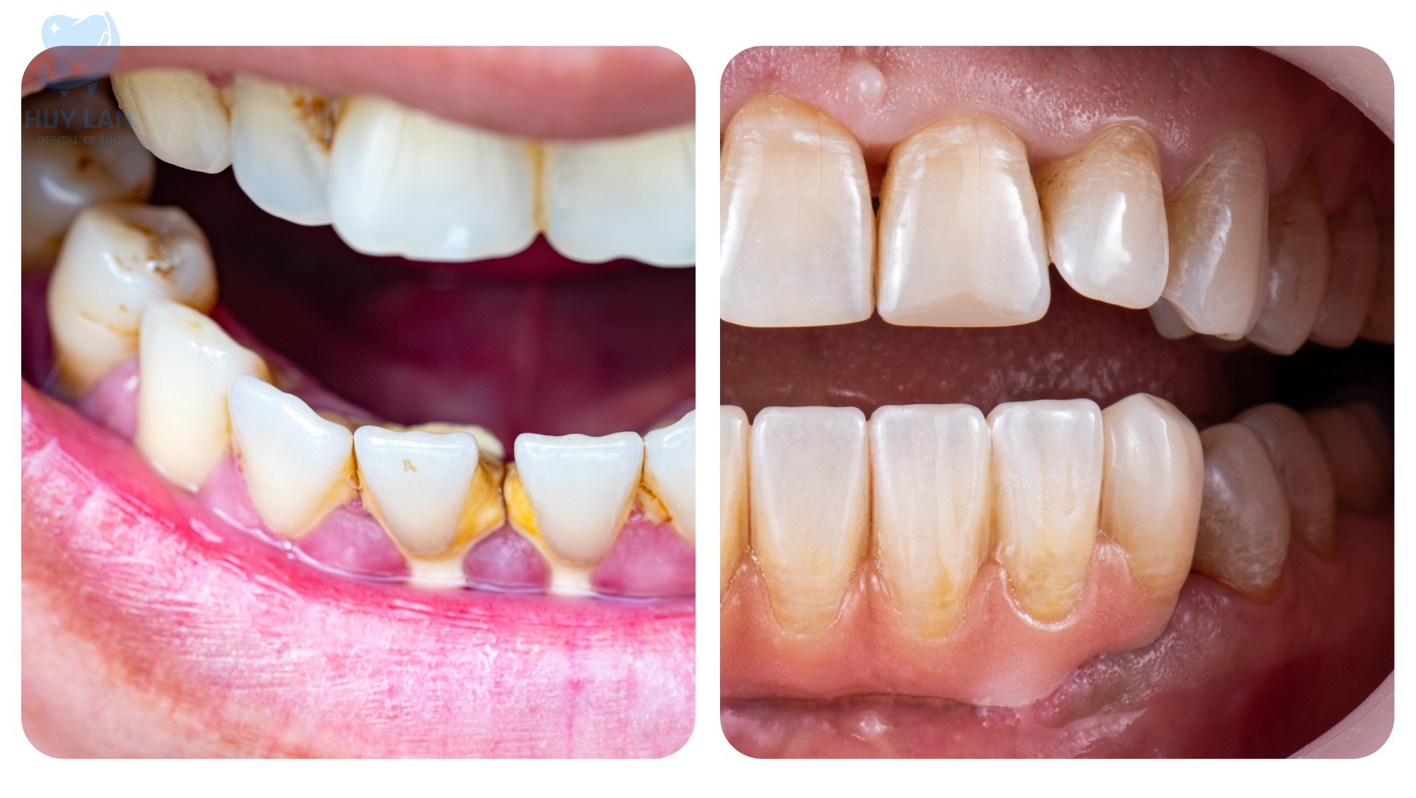 NHỮNG TRƯỜNG HỢP NÊN TẨY TRẮNG RĂNG