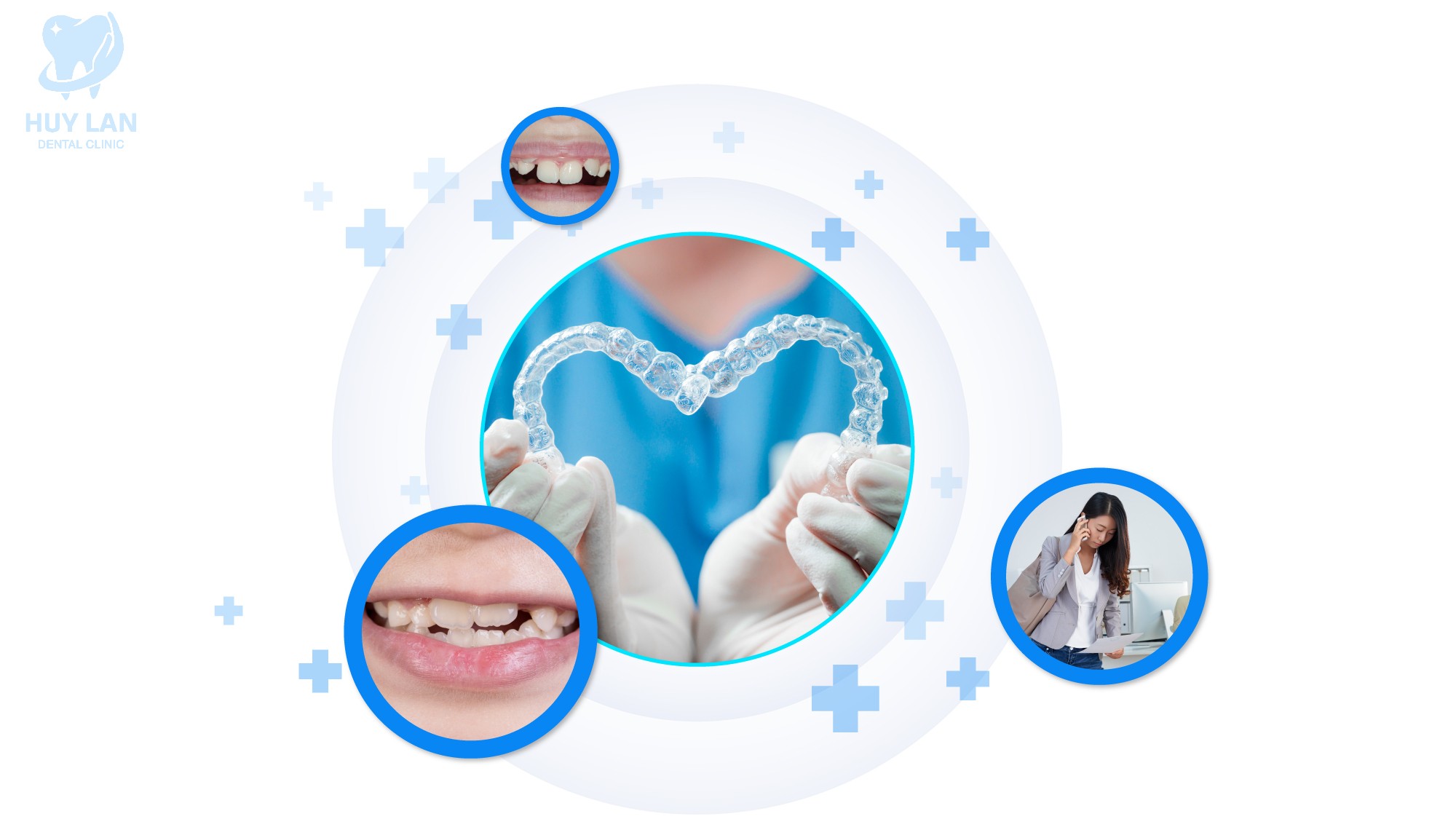 NHỮNG TRƯỜNG HỢP NÊN NIỀNG RĂNG TRONG SUỐT NHỮNG TRƯỜNG HỢP NÊN NIỀNG RĂNG TRONG SUỐT