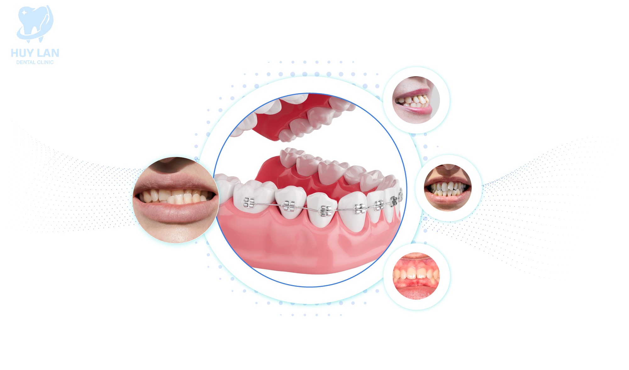 NHỮNG TRƯỜNG HỢP NÊN NIỀNG RĂNG SỚM  