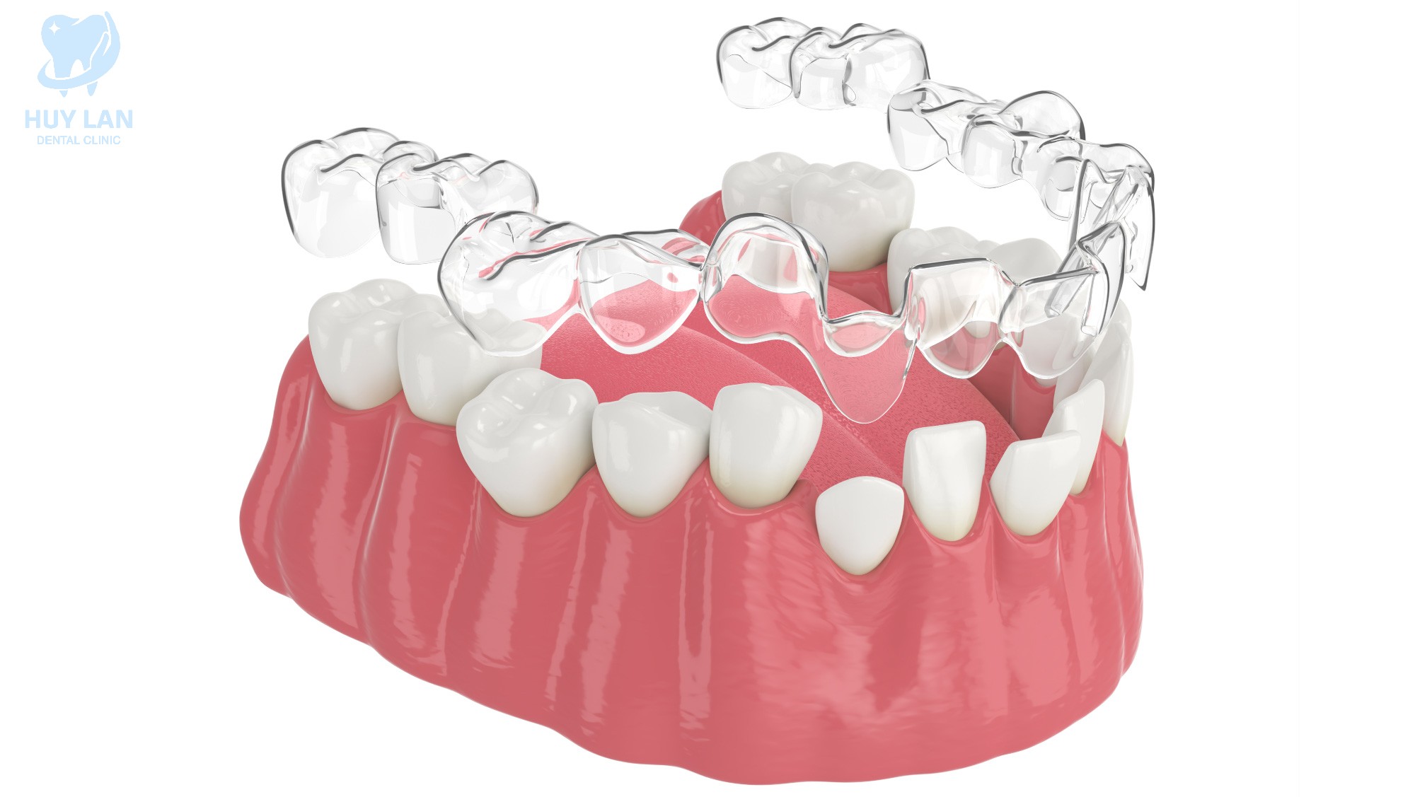 NIỀNG RĂNG TRONG SUỐT LÀ GÌ? NIỀNG RĂNG TRONG SUỐT LÀ GÌ?