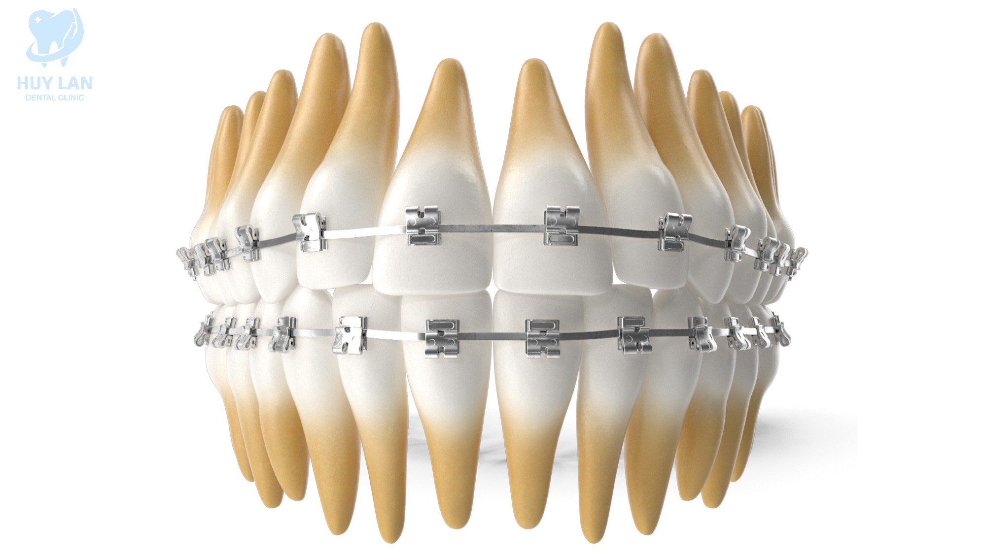 NIỀNG RĂNG LÀ GÌ?