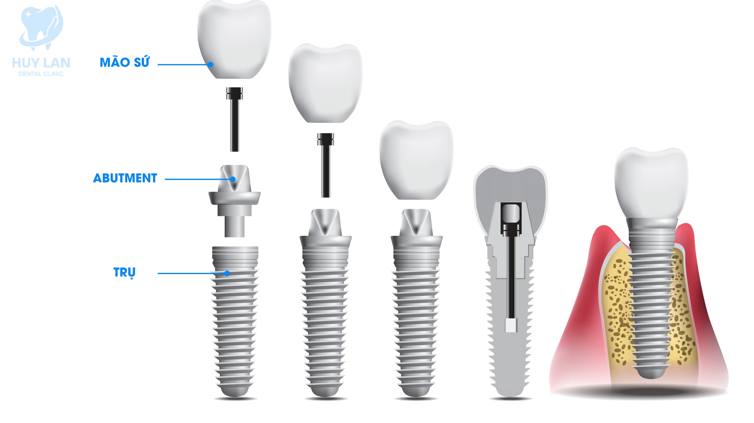 CẤU TẠO IMPLANT