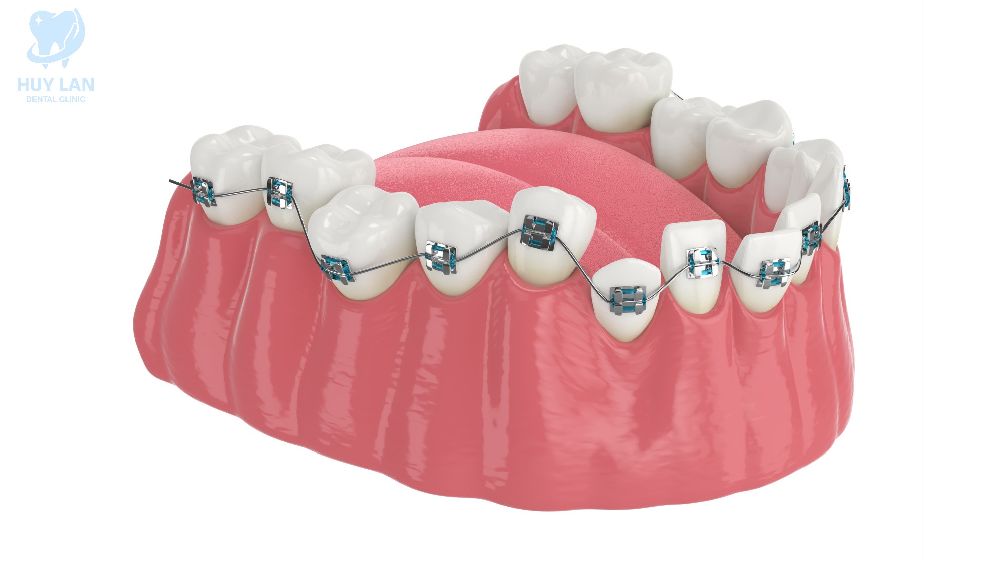 NIỀNG RĂNG MẮC CÀI  <br> LÀ GÌ?