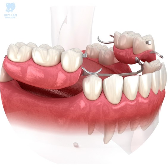 Răng giả tháo lắp