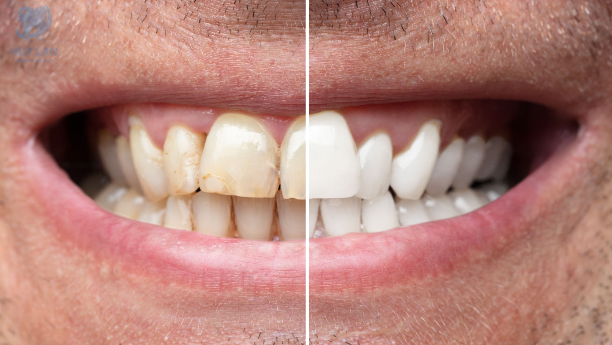 TẨY TRẮNG RĂNG LÀ GÌ?