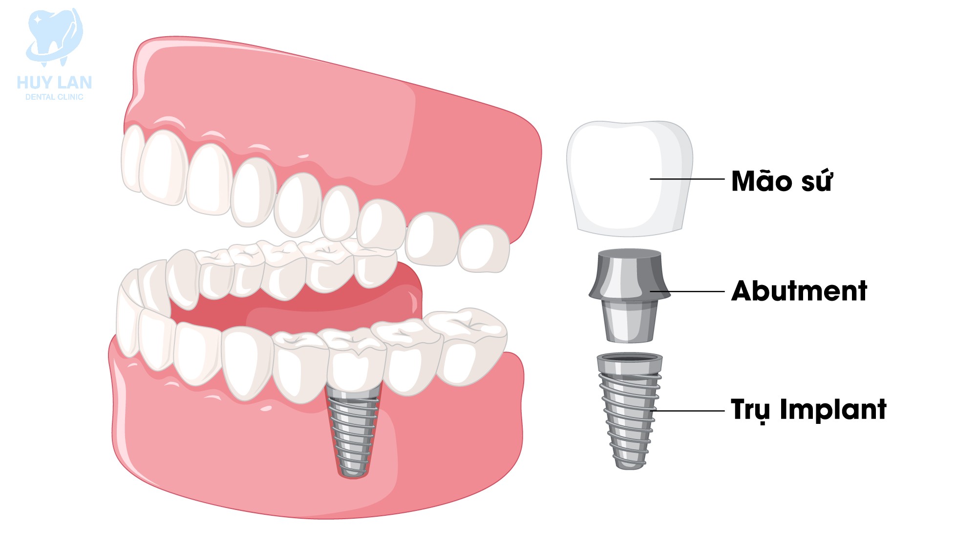 TRỒNG RĂNG IMPLANT ĐƠN LẺ LÀ GÌ?
