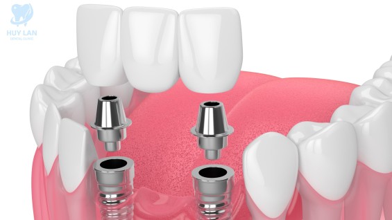 Trồng răng Implant đơn lẻ khi mất vài răng liền kề