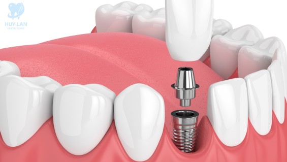 Trồng răng Implant đơn lẻ khi mất 1 răng