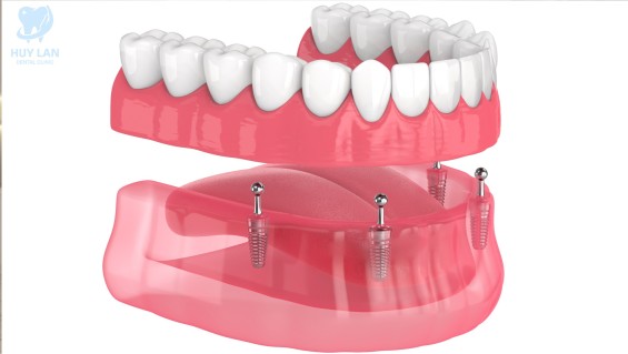 Trồng Răng Implant All-on-4
