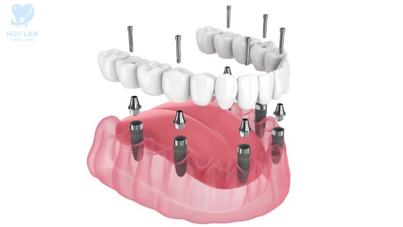 Trồng Răng Implant All-on-6