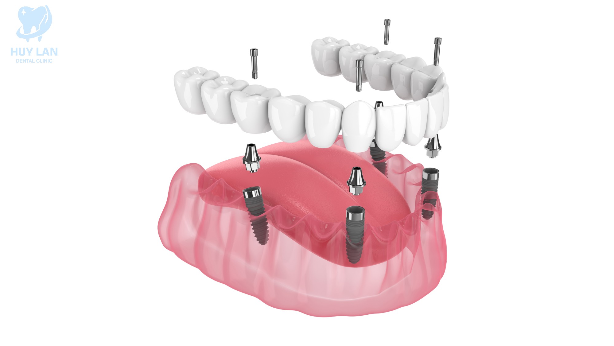 TRỒNG RĂNG IMPLANT TOÀN HÀM LÀ GÌ? TRỒNG RĂNG IMPLANT TOÀN HÀM LÀ GÌ?