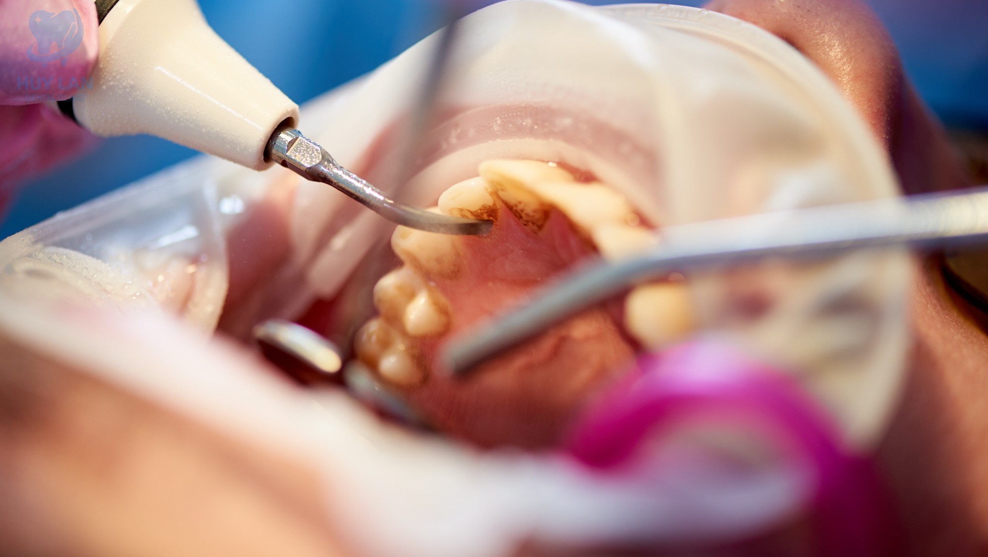 TRƯỜNG HỢP NÀO NÊN SỬ DỤNG  <br>DỊCH VỤ CẠO VÔI, ĐÁNH BÓNG RĂNG