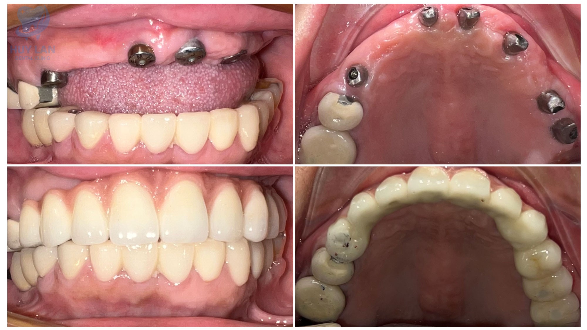 NHỮNG ƯU ĐIỂM <br>CỦA TRỒNG RĂNG <br>IMPLANT TOÀN HÀM NHỮNG ƯU ĐIỂM <br>CỦA TRỒNG RĂNG <br>IMPLANT TOÀN HÀM